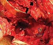 مراقبة المريض خلال المرحلة الانتقالية