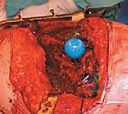 زراعة مفصل المراجعة النهائي وتثبيته