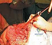 الأشعة السينية النهائية بعد نجاح العملية