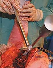 إعادة زرع مفصل الورك على مرحلتين: حل نهائي لعدوى المفاصل الصناعية