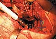 إزالة المباعد وتجهيز العظم للزراعة النهائية