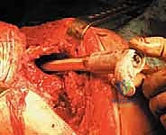 صورة توضيحية لـ إعادة زرع مفصل الورك على مرحلتين: حل نهائي لعدوى المفاصل الصناعية