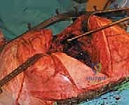 صورة توضيحية لـ إعادة زرع مفصل الورك على مرحلتين: حل نهائي لعدوى المفاصل الصناعية