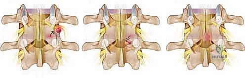 صورة توضيحية لـ استئصال الغضروف المجهري القطني: دليل شامل للمرضى من الأستاذ الدكتور محمد هطيف