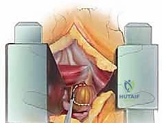 صورة توضيحية لـ استئصال الغضروف المجهري القطني: دليل شامل للمرضى من الأستاذ الدكتور محمد هطيف