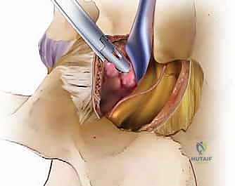 صورة توضيحية لـ استئصال الغضروف المجهري القطني: دليل شامل للمرضى من الأستاذ الدكتور محمد هطيف