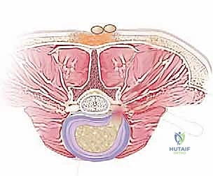 صورة توضيحية لـ استئصال الغضروف المجهري القطني: دليل شامل للمرضى من الأستاذ الدكتور محمد هطيف