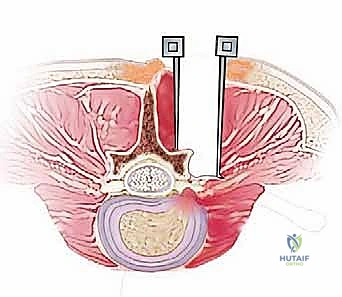 صورة توضيحية لـ استئصال الغضروف المجهري القطني: دليل شامل للمرضى من الأستاذ الدكتور محمد هطيف
