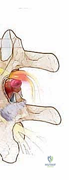 صورة طبية: استئصال الغضروف المجهري القطني: دليل شامل للمرضى من الأستاذ الدكتور محمد هطيف