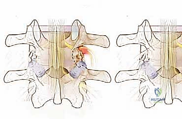 صورة طبية: استئصال الغضروف المجهري القطني: دليل شامل للمرضى من الأستاذ الدكتور محمد هطيف