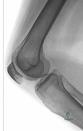 تشريح دقيق للرضفة والسطح المفصلي