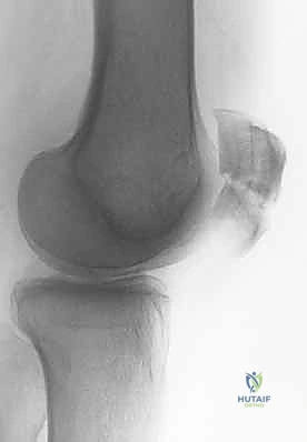 صورة طبية: كسر الرضفة: دليل شامل لعملية التثبيت الداخلي بالأسلاك (ORIF) مع الأستاذ الدكتور محمد هطيف