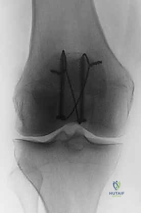 صورة توضيحية لـ كسر الرضفة: دليل شامل لعملية التثبيت الداخلي بالأسلاك (ORIF) مع الأستاذ الدكتور محمد هطيف