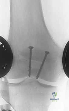 Patellar Fracture ORIF: An Intraoperative Masterclass in Tension Band Wiring