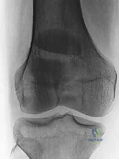 صورة طبية: كسر الرضفة: دليل شامل لعملية التثبيت الداخلي بالأسلاك (ORIF) مع الأستاذ الدكتور محمد هطيف