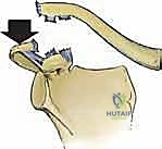 صورة توضيحية لـ إعادة البناء الجراحي الشامل لإصابات مفصل الكتف الأخرمي الترقوي: دليل المريض