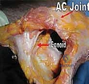 صورة توضيحية لـ إعادة البناء الجراحي الشامل لإصابات مفصل الكتف الأخرمي الترقوي: دليل المريض