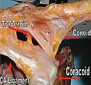 صورة توضيحية لـ إعادة البناء الجراحي الشامل لإصابات مفصل الكتف الأخرمي الترقوي: دليل المريض