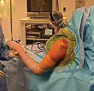 بروز عظمة الترقوة - علامة مفتاح البيانو