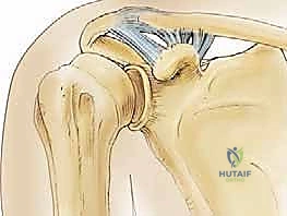 صورة رنين مغناطيسي توضح تمزق الأربطة