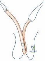 التخطيط الجراحي لإعادة البناء