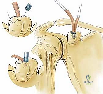 إعداد الرقعة الوترية للزراعة