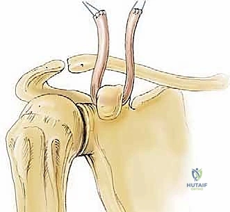 استخدام المنظار الجراحي في الكتف