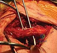 تثبيت الترقوة في مكانها التشريحي