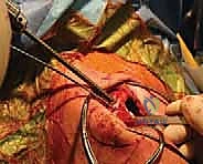 تمرير الخيوط الجراحية القوية