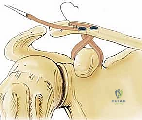 الأشعة السينية لتشخيص درجة الإصابة