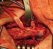 صورة شعاعية تظهر خلع المفصل الأخرمي الترقوي