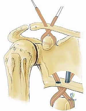 تقييم درجة الإصابة في مفصل الكتف