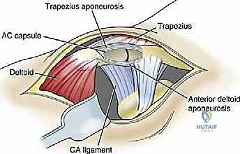 صورة توضيحية لـ إعادة البناء الجراحي الشامل لإصابات مفصل الكتف الأخرمي الترقوي: دليل المريض
