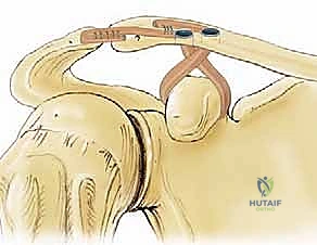 صورة توضيحية لـ إعادة البناء الجراحي الشامل لإصابات مفصل الكتف الأخرمي الترقوي: دليل المريض