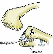 صورة توضيحية لـ إعادة البناء الجراحي الشامل لإصابات مفصل الكتف الأخرمي الترقوي: دليل المريض