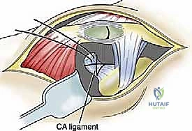 تنظيف المفصل وتحضير العظام