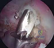 صورة توضيحية لـ إعادة البناء الجراحي الشامل لإصابات مفصل الكتف الأخرمي الترقوي: دليل المريض