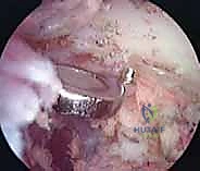 الإغلاق التجميلي للجرح