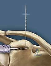 صورة توضيحية لـ إعادة البناء الجراحي الشامل لإصابات مفصل الكتف الأخرمي الترقوي: دليل المريض