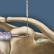العودة للنشاط الرياضي الطبيعي