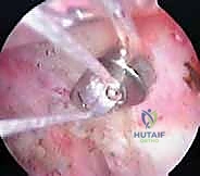 صورة توضيحية لـ إعادة البناء الجراحي الشامل لإصابات مفصل الكتف الأخرمي الترقوي: دليل المريض