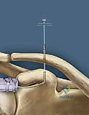 استخدام تقنية التثبيت بالخيوط القوية