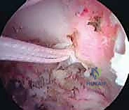 تمارين العلاج الطبيعي في المرحلة الأولى