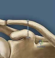 Illustration of around the coracoid - Dr. Mohammed Hutaif