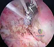 صورة توضيحية لـ إعادة البناء الجراحي الشامل لإصابات مفصل الكتف الأخرمي الترقوي: دليل المريض