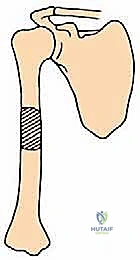 Humeral Metastasis Management: An Intraoperative Masterclass in Resection & Reconstruction