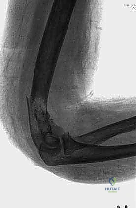 التعامل مع الأوعية الدموية الدقيقة