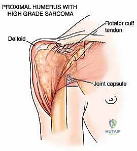 صورة طبية: علاج نقائل العضد السرطانية جراحياً في صنعاء استئصال وإعادة بناء متقدمة