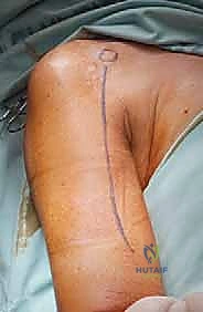 علاج نقائل العضد السرطانية جراحياً في صنعاء استئصال وإعادة بناء متقدمة