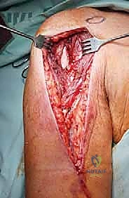 تخطيط جراحي لنقائل العضد